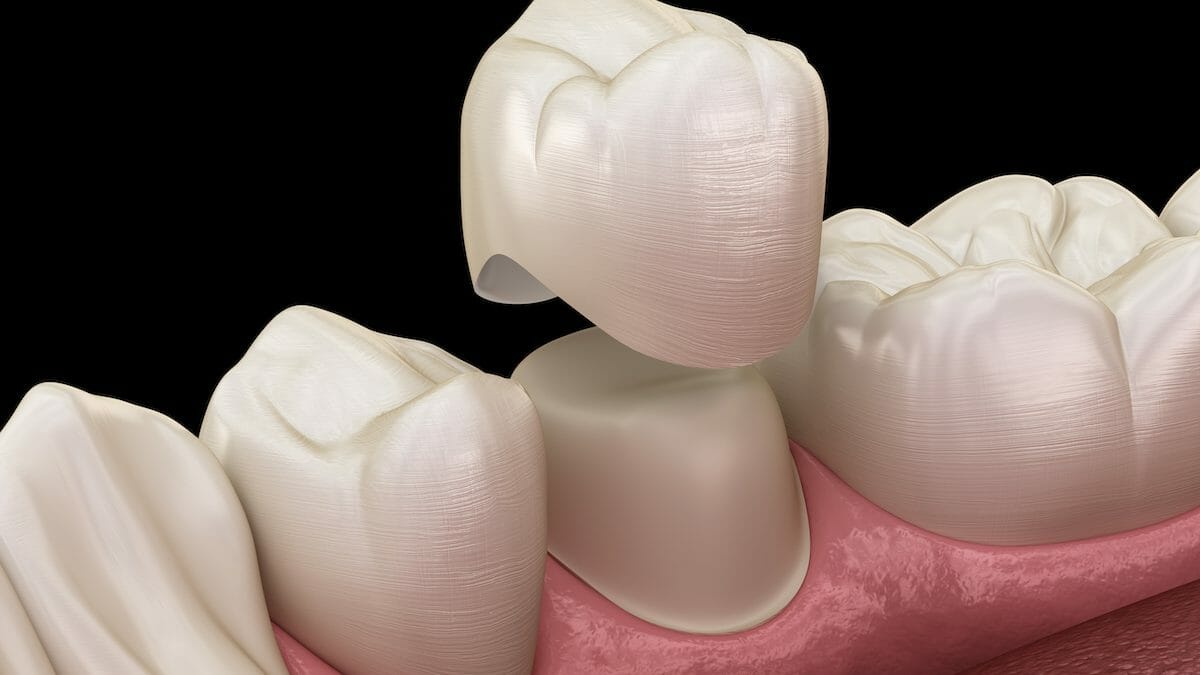 What is a Porcelain Tooth Crown