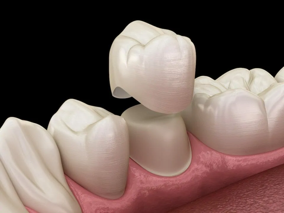 What is a Porcelain Tooth Crown