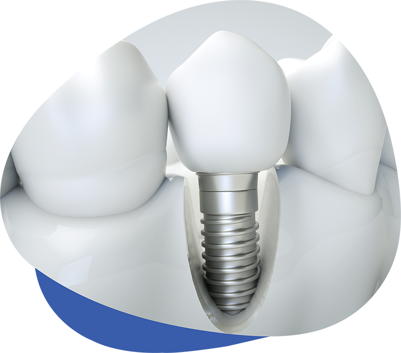 Dental Implant