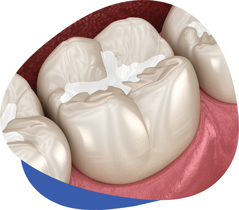 Sealants Sealants
