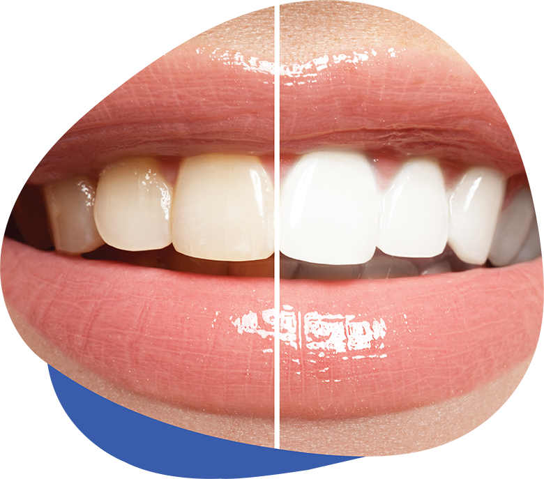 SouthWest Dental - Dentist Cathedral City - Dentist Rancho Mirage - Teeth  Whitening