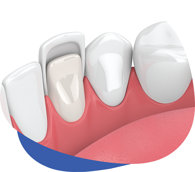 Veneers