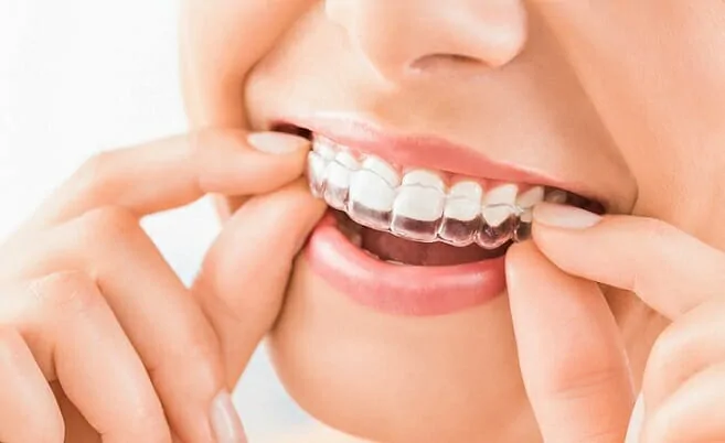 invisible teeth straightener