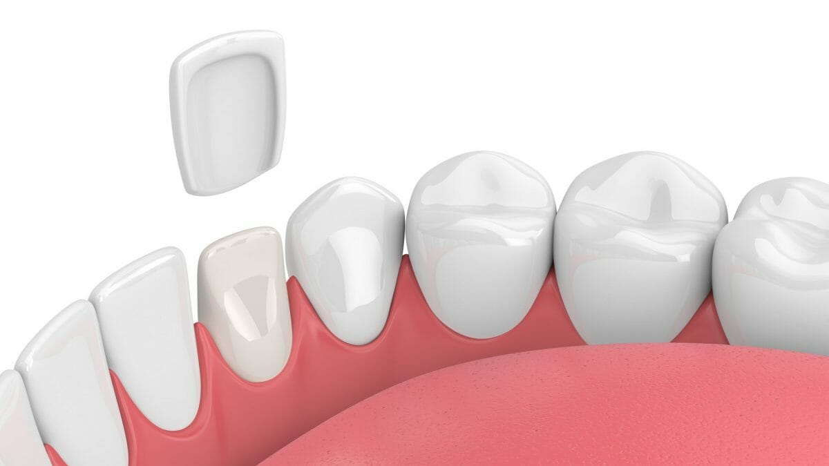 Dental veneer