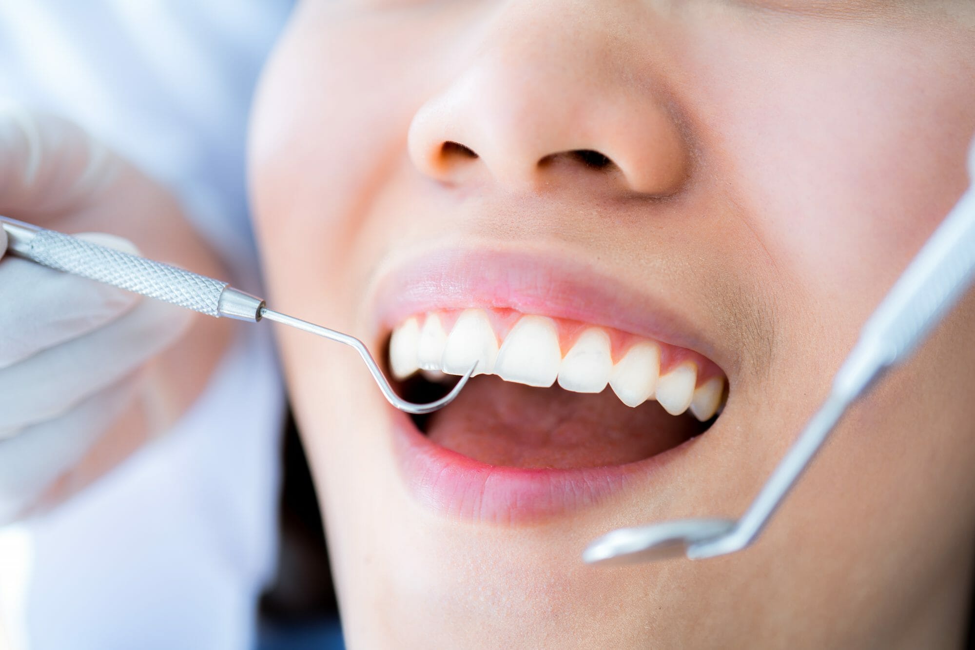 fósil Semicírculo Judías verdes Will Teeth Cleaning Remove Stains? - Westerville Dental Associates