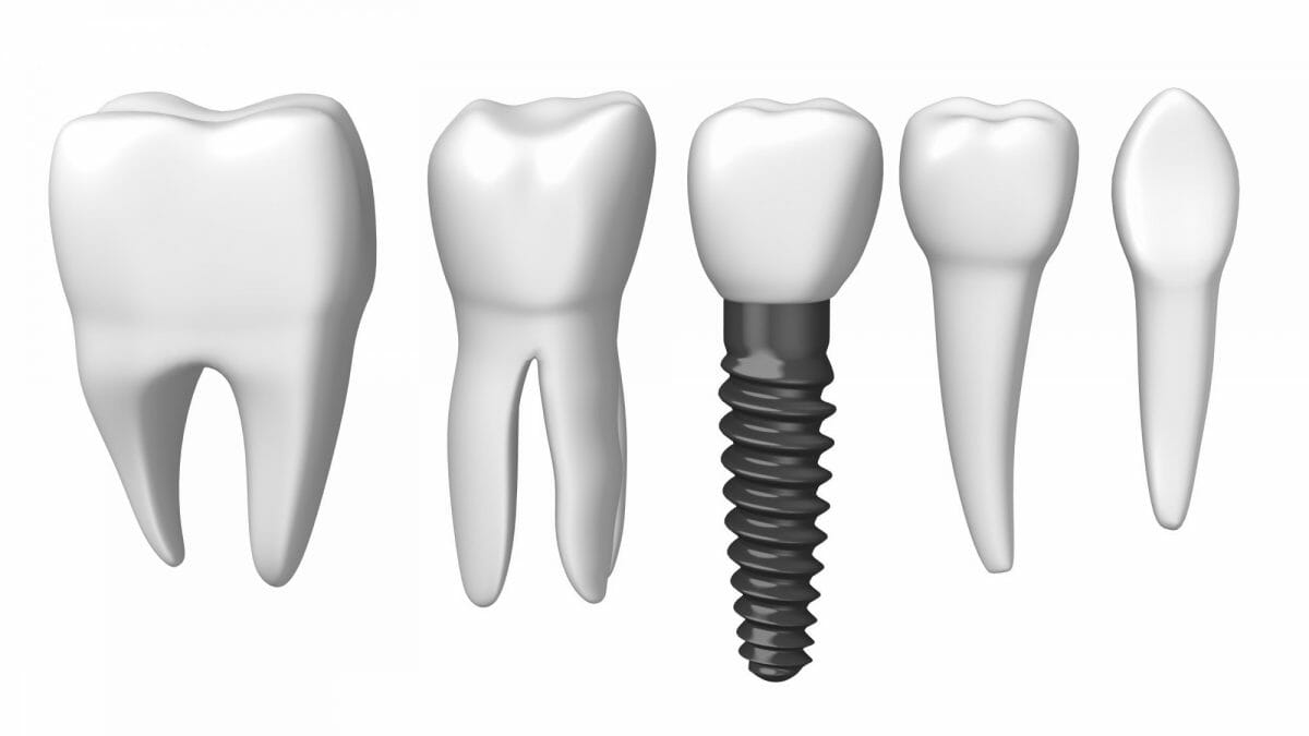 teeth and implant