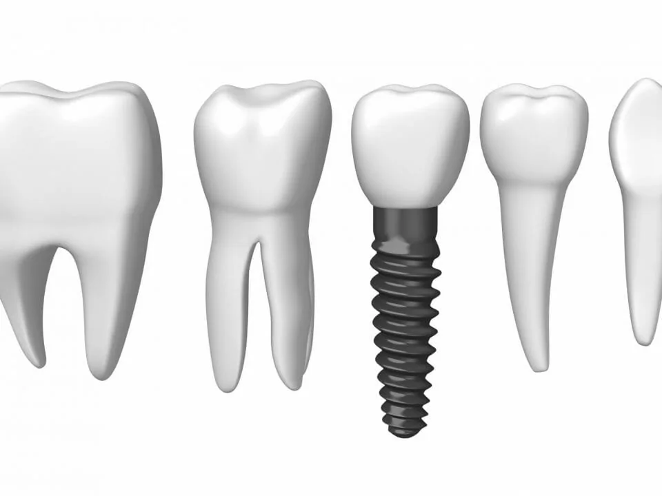 teeth and implant