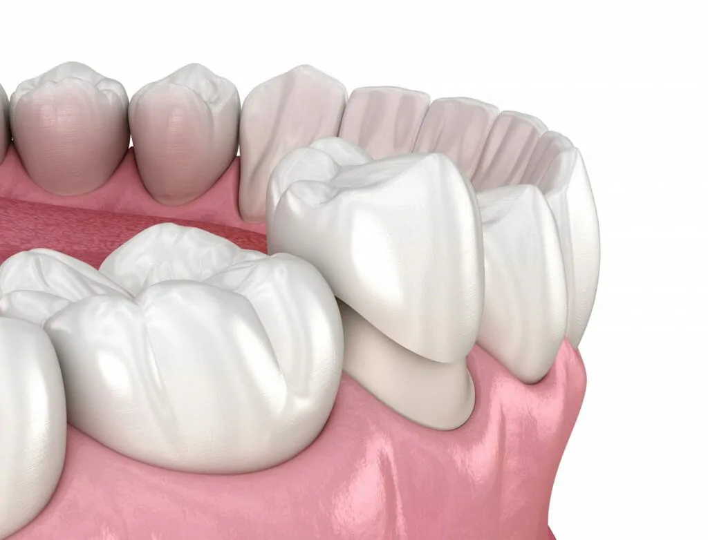 Types of Dental Crown Material 