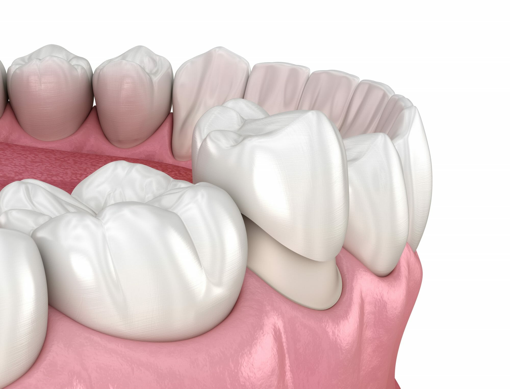 Dental Crown Materials - Westerville Dental Associates
