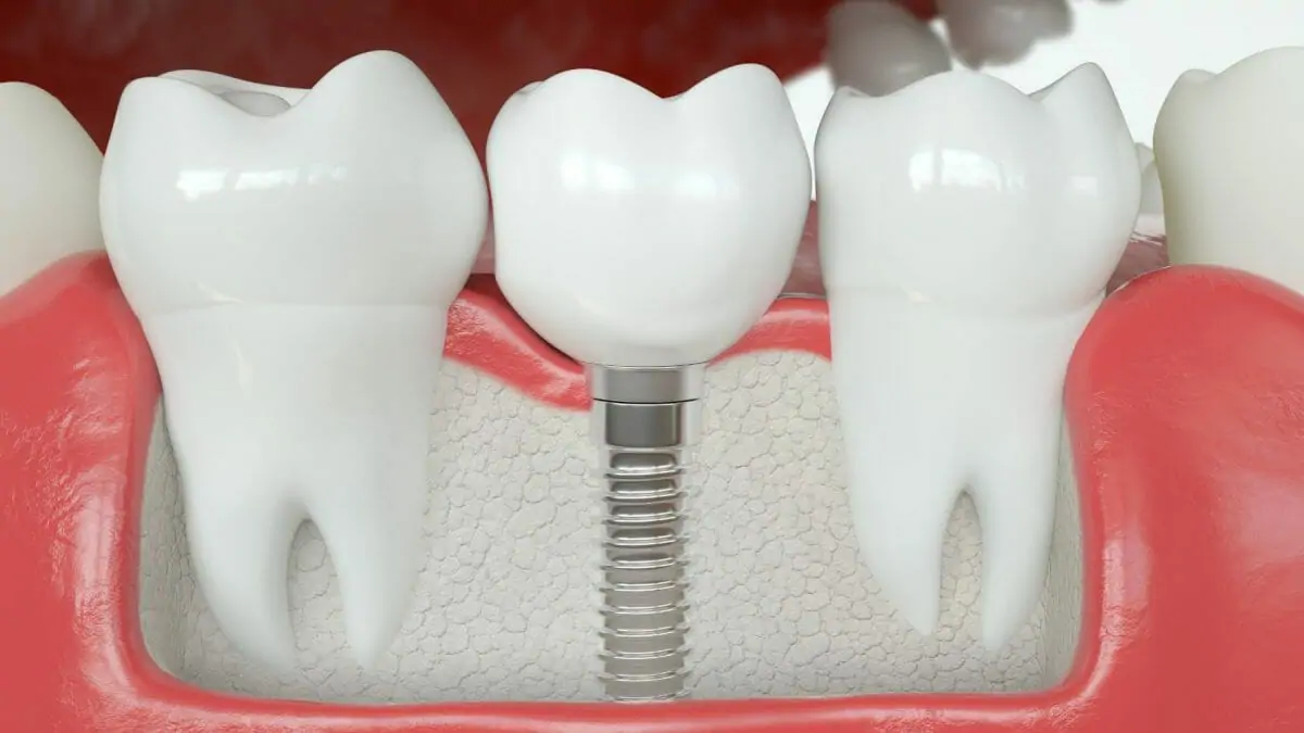 dental crown compared to a dental implant