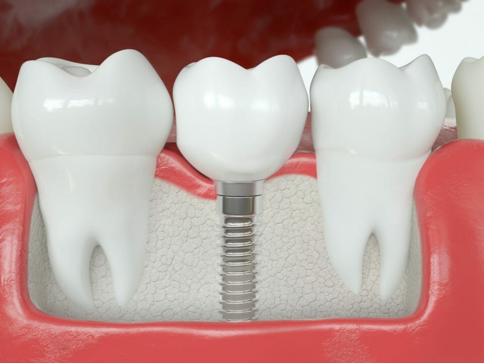 dental crown compared to a dental implant