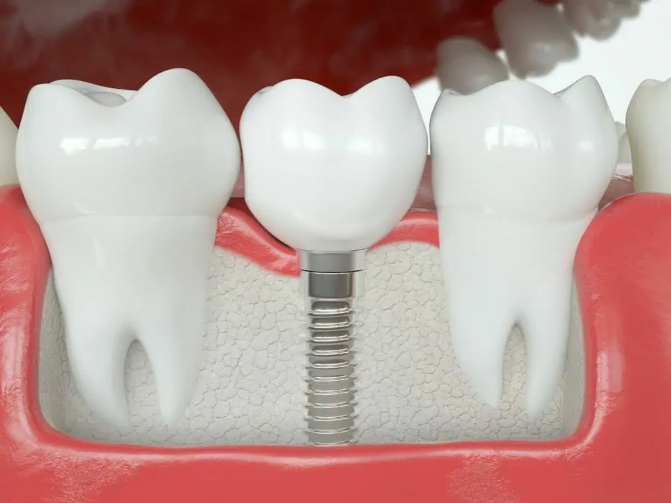 dental crown compared to a dental implant