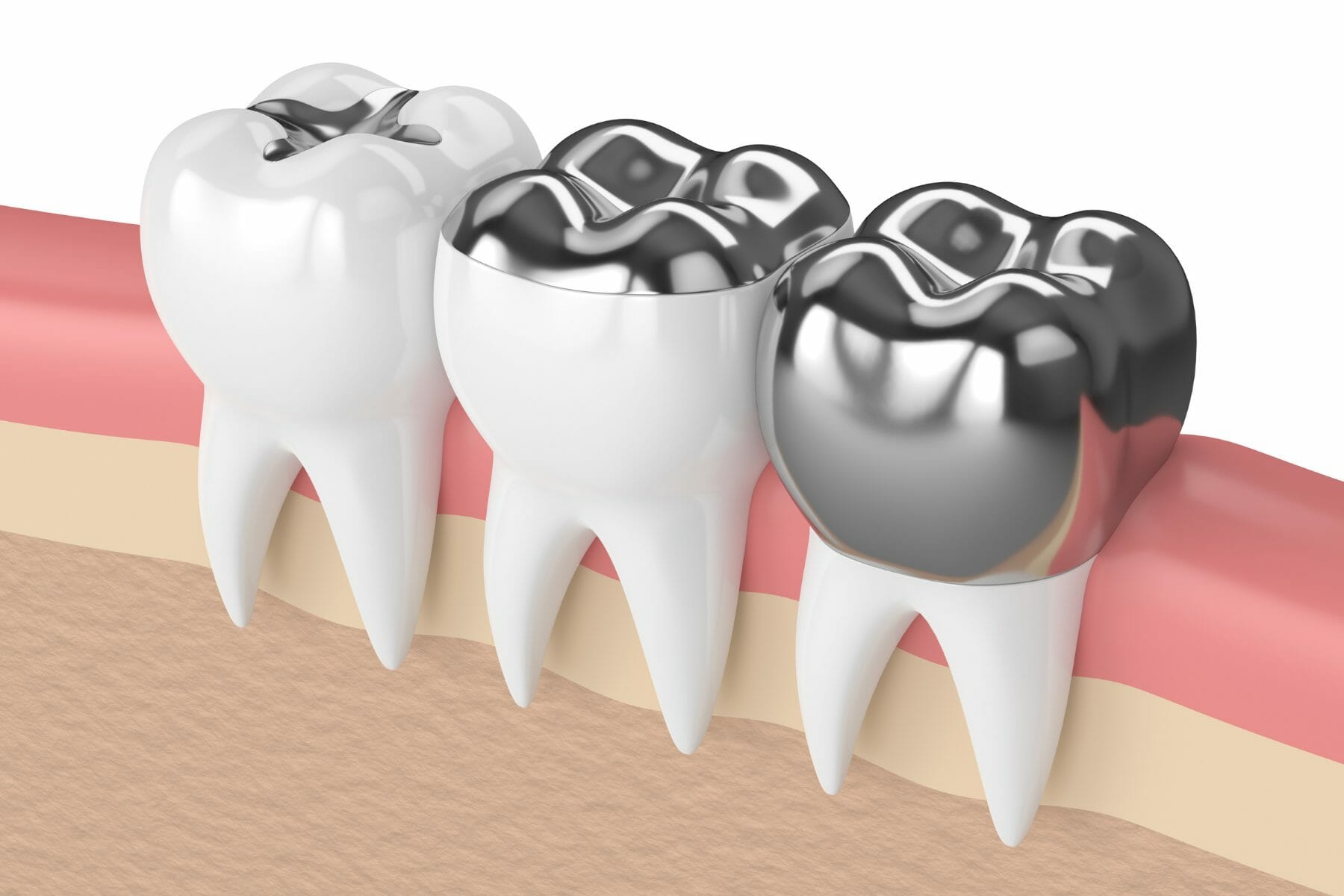 What is used shop for filling teeth