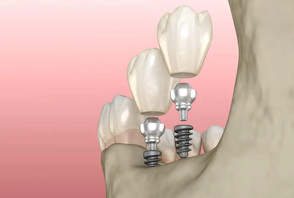 teeth implant screws recessed into jaw bone