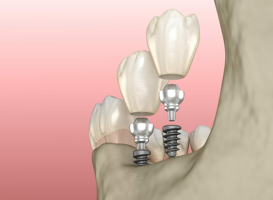 teeth implant screws recessed into jaw bone