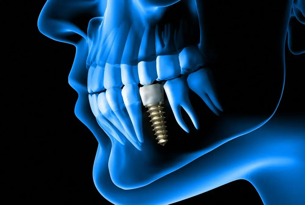 Animated X-Ray of Left Side of Jaw With Dental Implant