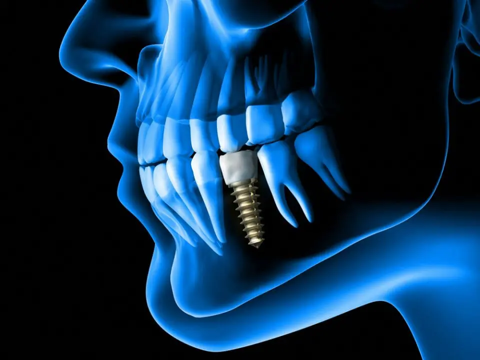 Animated X-Ray of Left Side of Jaw With Dental Implant