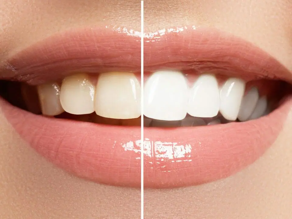 Teeth Whitening