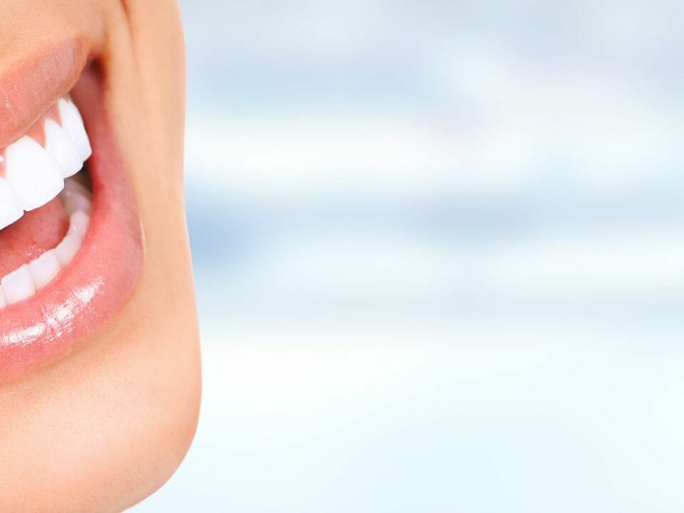 How long does teeth whitening take?