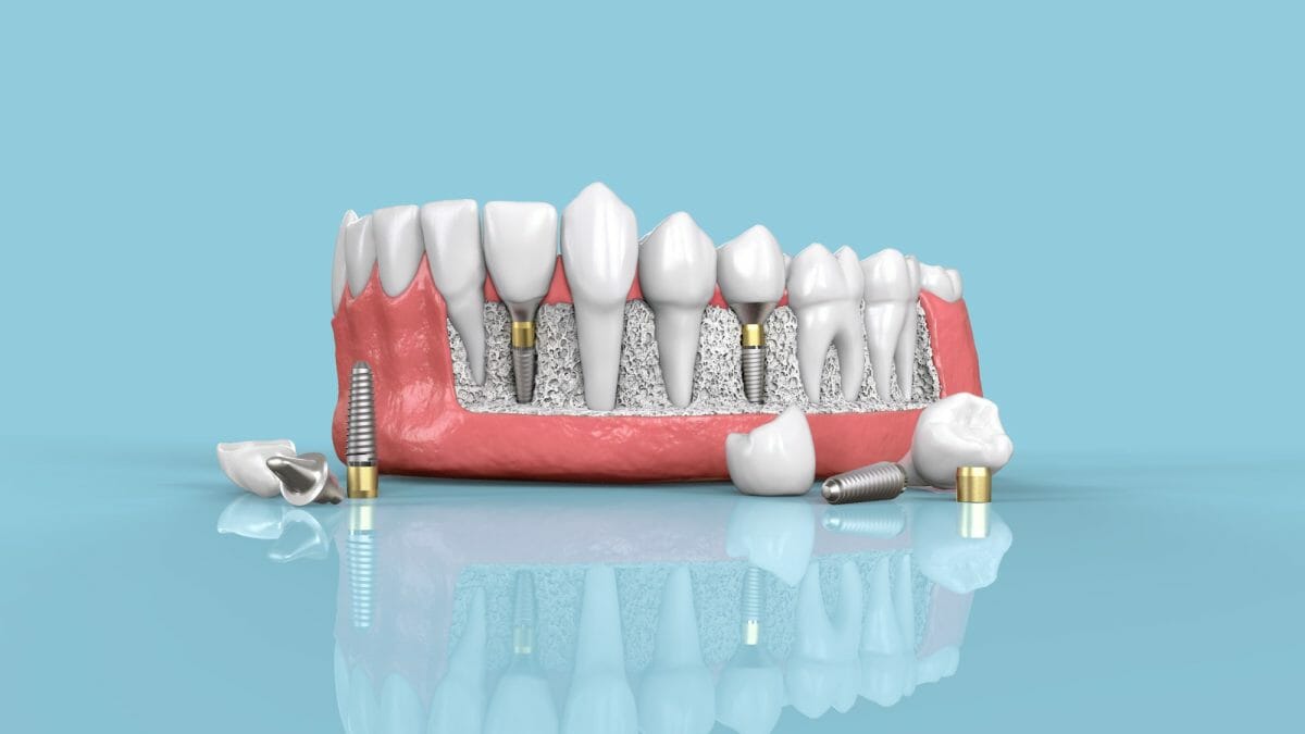 What should I expect when getting dental implants?