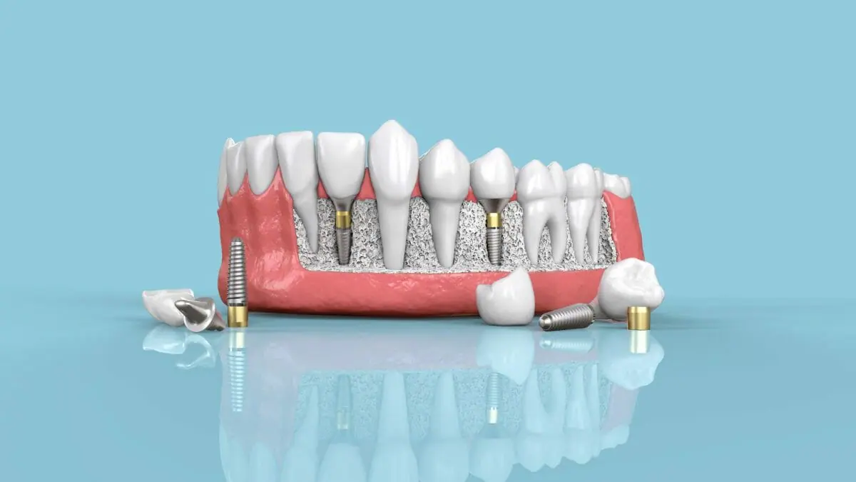 What should I expect when getting dental implants?