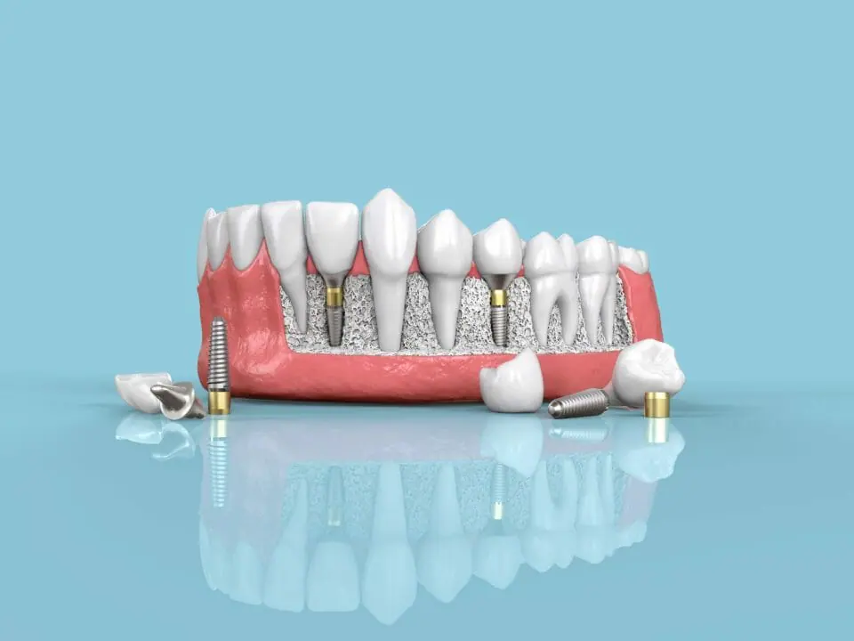 What should I expect when getting dental implants?