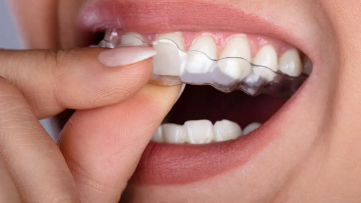 How to decide if Invisalign is for you