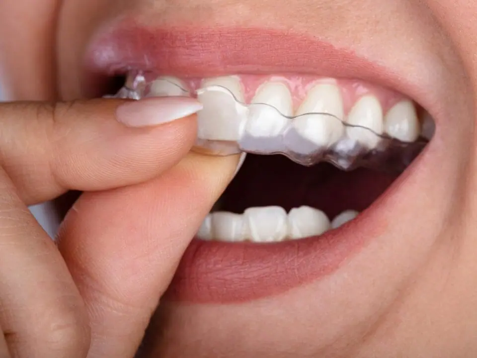 How to decide if Invisalign is for you