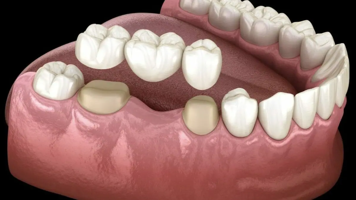 Dental bridge