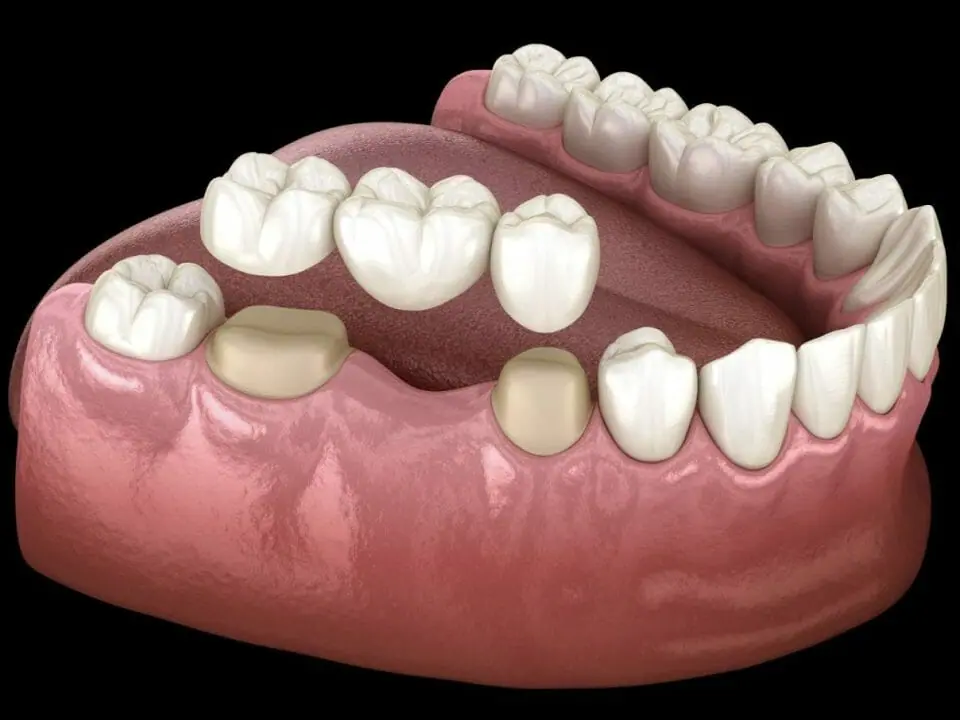 Dental bridge