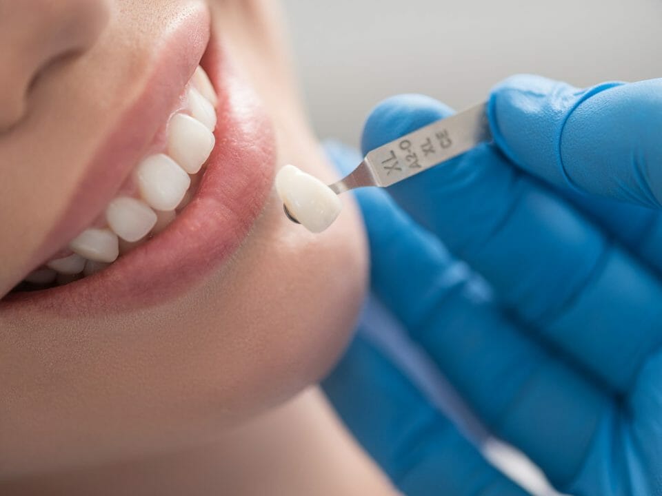 How Dental Crowns Can Improve Your Smile and Oral Health