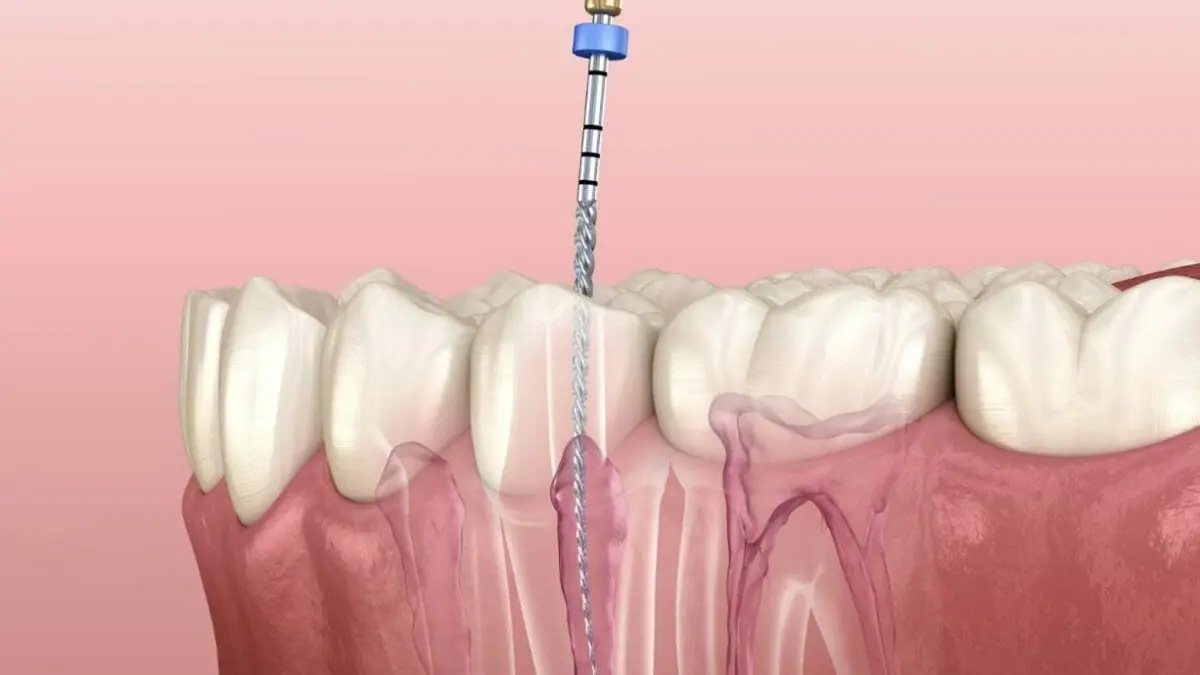 Root Canal