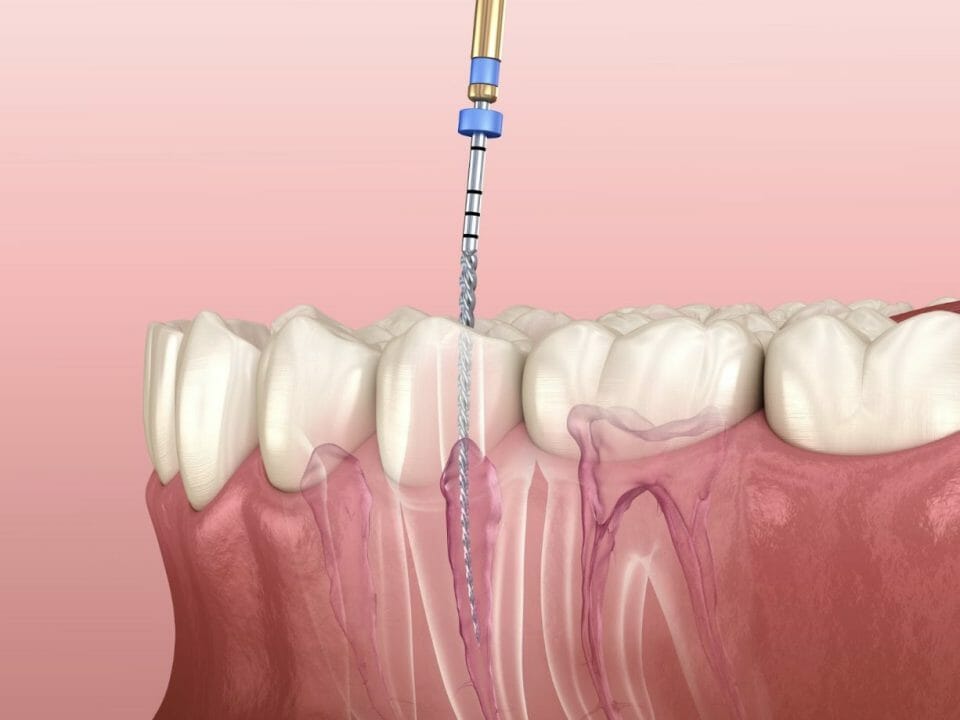 Root Canal