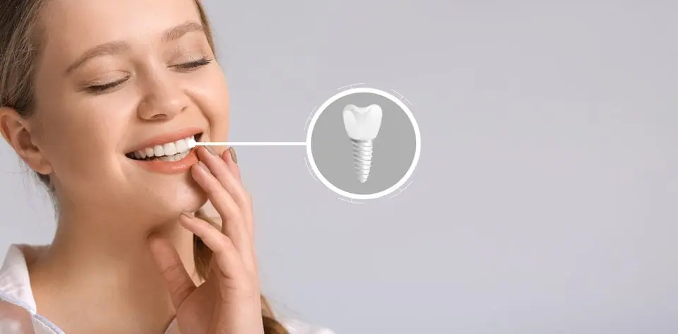 dental implant