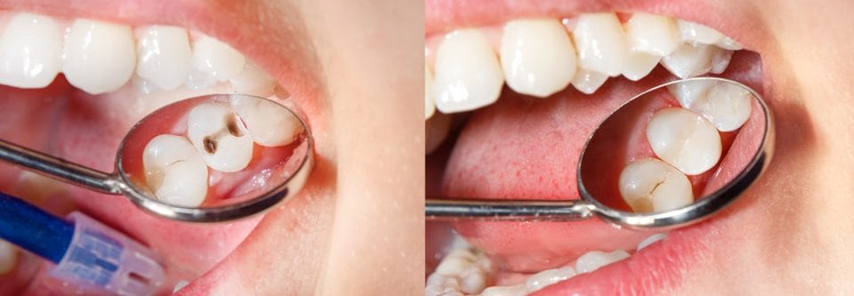 Understanding How a Filling Stops Tooth Decay