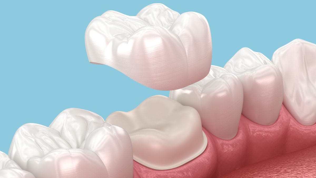 The Dental Crown Process: What to Expect from Start to Finish