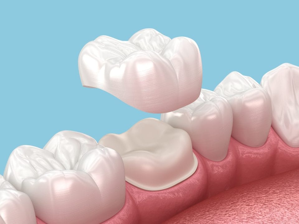 The Dental Crown Process: What to Expect from Start to Finish