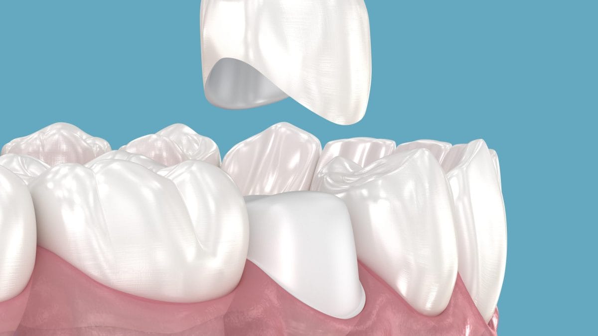 Spotting Early Tooth Fractures with Dental Crowns