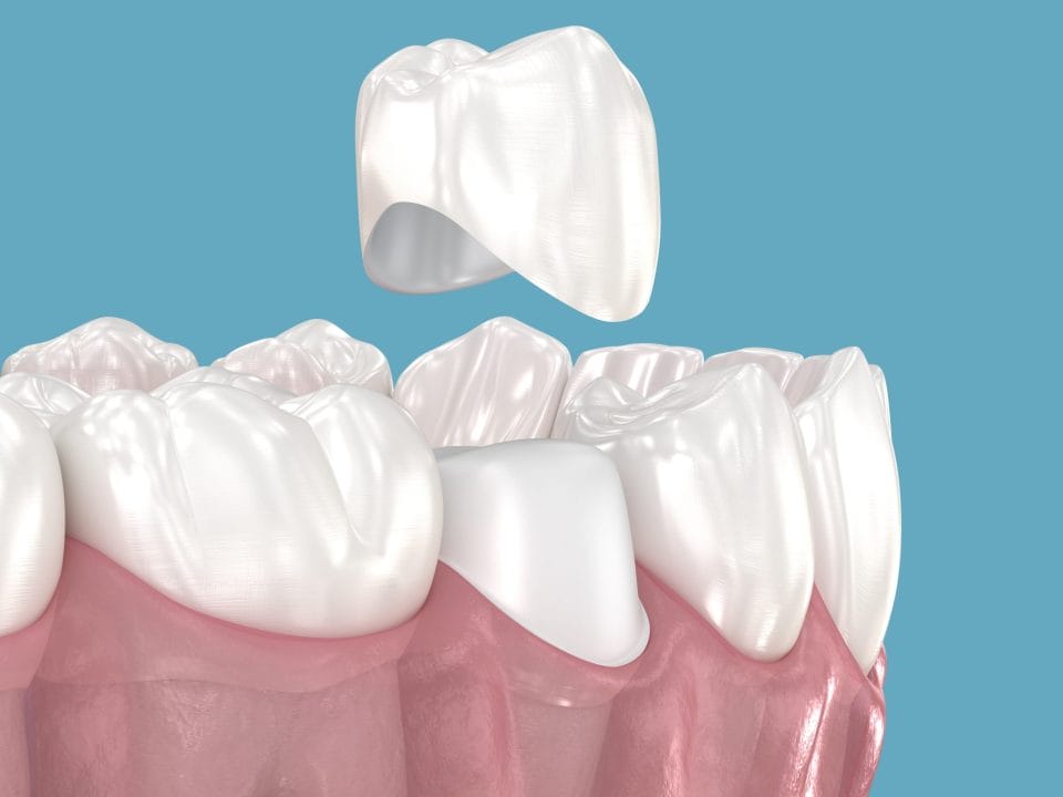 Spotting Early Tooth Fractures with Dental Crowns