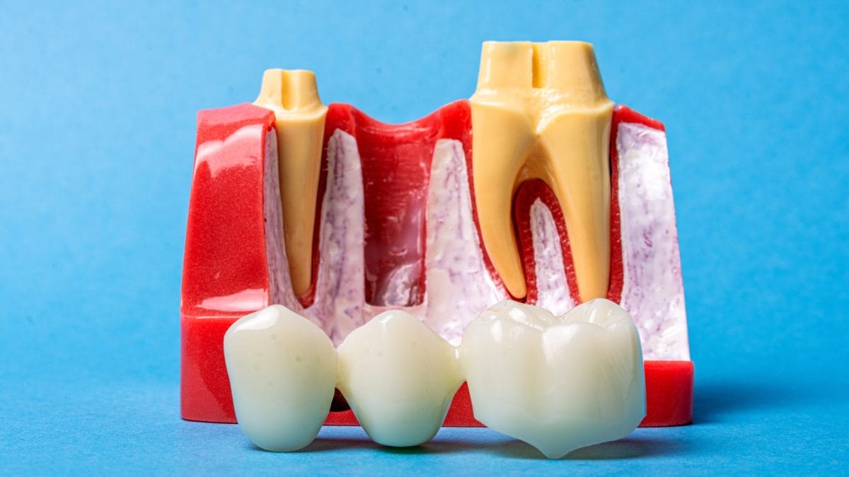 Dental Implants, Bridges, or Dentures: Which Tooth Replacement Option Is Right for You?