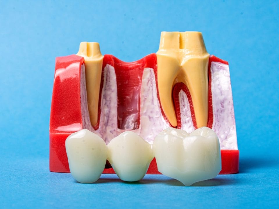 Dental Implants, Bridges, or Dentures: Which Tooth Replacement Option Is Right for You?